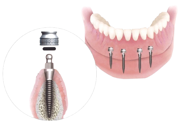 Acrylic Denture