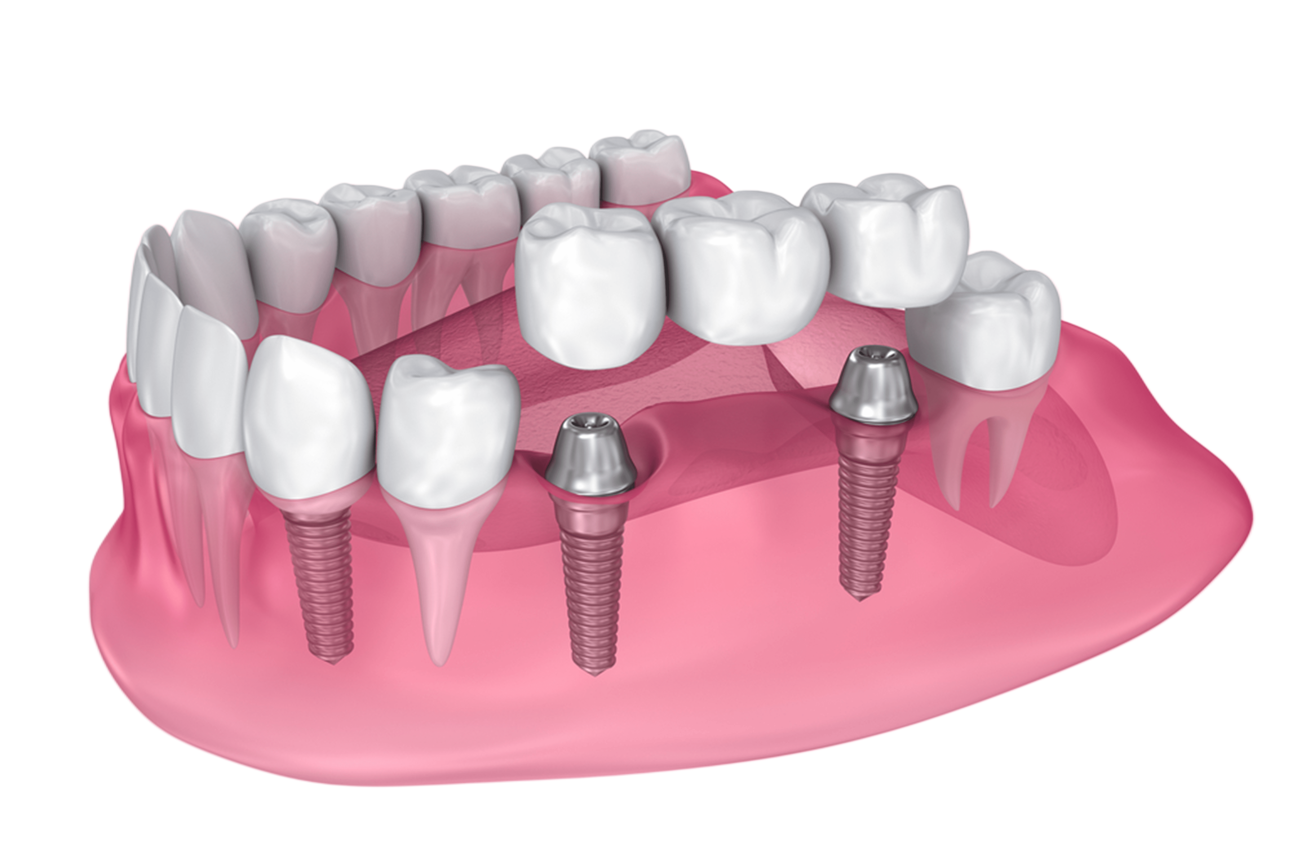 Implant Supported Partial