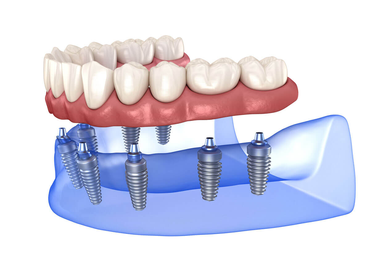 Zirconia Denture